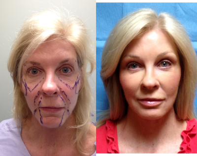 Facelift, Browlift with Autologous Fat Transfer as marked - Female patient with brow ptosis, facial laxity and lipo-atrophy who underwent Coronal Browlift, full SMAS Facelift with Platysmaplasty and Autologous Fat Transfer to all areas as marked including temples, sub-brow, and upper/lower lips.