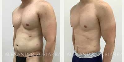 47 year old man treated with Liposuction - 47 year old man treated with Liposuction