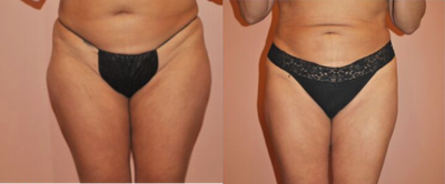 35-44 year old woman treated with Tickle Lipo - 36y/o female who had difficulty finding that right jeans to fit around her thighs. If the thighs fit, the waist was too big, if the waist fit, the thighs would be too tight and unfortunately would highlight her problem area. Now she feels much more proportional and her jeans fit in both waist and thighs.