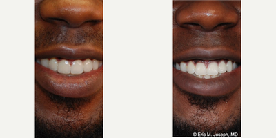 18-24 year old man treated with Lip Reduction - Our handsome 21 year old patient was self conscious about the appearance of his lower lip. He felt that it was droopy, and that there was too much pink mucous membrane showing while his mouth was open. These photos demonstrate a natural looking lower lip appearance 10 months after lower lip reduction surgery. His scar is invisible on the inside of his lower lip, and you can see less droopiness and less pink mucous membrane showing.
