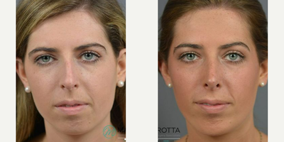 Woman treated with Rhinoplasty, Septoplasty - Just 1 year ago, this patient was wondering what it would be like to make her nose straighter and her profile more balanced. With Dr. Marottas help.Surgeon: Dr James MarottaProcedure: Septorhinoplasty & Chin Implant1 year post-op