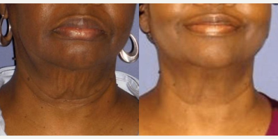 Woman treated with Fractora RF - 8 Fractora Firm Treatments