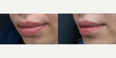 25-34 year old woman treated with Lip Reduction - Lower Lip Reduction surgery 7 weeks post operative