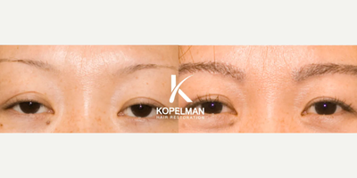 25-34 year old woman treated with Eyebrow Transplant - Age: 29Gender: FemaleProcedure: Eyebrow Hair TransplantGrafts: 550Procedure Description: Aimed to fill in over-plucked areas for a fuller look. Photos taken before and nine months after the procedure.
