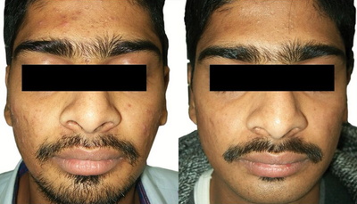 Venus Viva - Before and After 5 Treatments. Photos provided courtesy of Venus Concept, performed by Megha Joy Shah, MD.