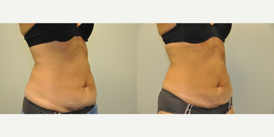 44 year old woman treated with CoolSculpting - 44 year old female shown 8 weeks after coolsculpting of the lower abdomen