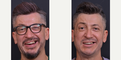 35-44 year old man treated with Facial Reconstructive Surgery - Facial Synkinesis Surgery, Selective Denervation Surgery, Selective Neurolysis Surgery, Selective Neuroectomy Surgery