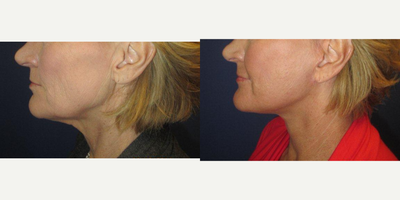 55-64 year old woman treated with Facelift - This patient had a facelift and neck lift comfortably under local anesthesia (no general anesthesia).