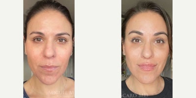 Woman treated with Brow Lift - Woman treated with Brow Lift and Lip Lift
