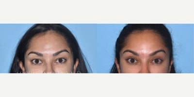 Woman treated with Eyelid Surgery - Woman treated with Eyelid Surgery through upper blepharoplasty with a little fat transposition and reconstruction of the muscular crease. Patient is shown before and 4 months post-op.