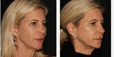 Woman treated with Emface - Emface