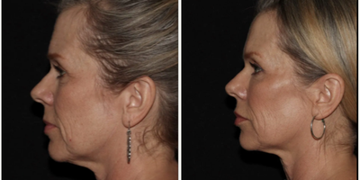Woman treated with Emface - Emface