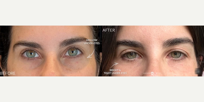 Woman treated with PlasmaPen - Woman treated with PlasmaPen