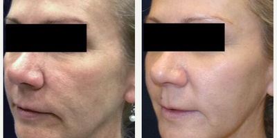 Woman treated with Neo Laser - Woman treated with Neo Laser