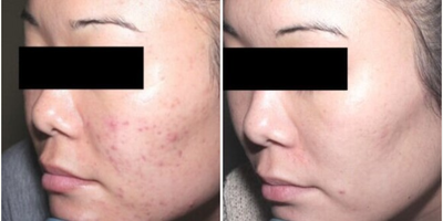 Woman treated with Neo Laser - Woman treated with Neo Laser