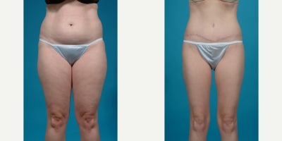 25-34 year old woman treated with Abdominal Etching, Diastasis Recti Repair, Drainless Tummy Tuck, Liposculpture, Liposuction, M - Standard tummy tuck with VASER ultrasound liposuction 360 and corset muscle plication.