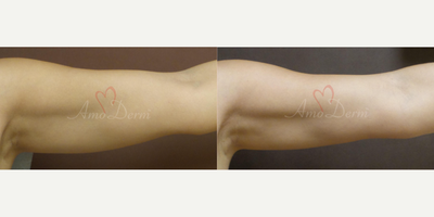 55-64 year old woman treated with Skin Rejuvenation, Venus Freeze, Skin Tightening - Non-surgical skin tightening, body sculpting & contouring & fat reduction with Venus Freeze (radiofrequency)
