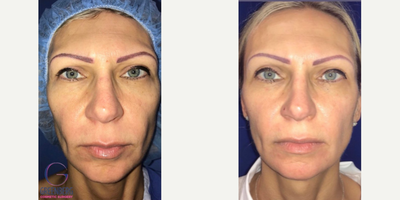 Woman treated with Chin Implant - Woman treated with Chin Implant and Facial Fat Transfer to create facial harmony and improve symmetry.