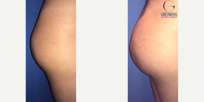 Woman treated with Liposuction, Butt Augmentation - Woman treated with Liposuction, Butt Augmentation