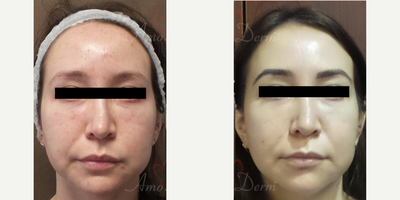 35-44 year old woman treated with VI Peel - 4D Under Eye Lift - Treatment of dark circles & bags under eyes and cheek restoration with Belotero, Restylane, Volbella and Voluma