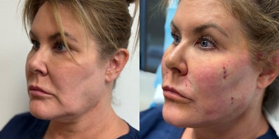 45-54 year old woman treated with Lifestyle Lift - 46 year old female who wanted a facial lift without undergoing surgery. Before and after are the same day