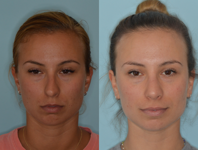 25-34 year old woman treated with Septoplasty - A doctorpresents a patient with a deviated nose where an advanced technique was utilized called an extracorporeal septoplasty. In this technique the entire septum is removed and reconstructed to help provide for the best improvement in the deviation of the nose.