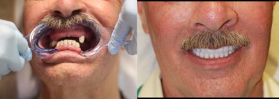 55 year old male treated with All-on-4 Procedure - 55 year old male treated with All-on-4 Procedure