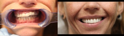 26 year old female treated with All-on-4 Dental Implant Procedure - 26 year old female treated with All-on-4 Dental Implant Procedure
