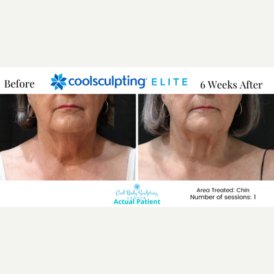 65-74 year old woman treated with CoolSculpting Elite - CoolSculpting results on Chin