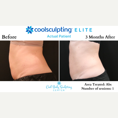 35-44 year old woman treated with CoolSculpting Elite - CoolSculpting Elite before and after