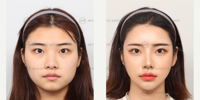 18-24 year old woman treated with Jaw Reduction, Genioplasty, Cheekbone Reduction, Facial Fat Transfer, Asian Rhinoplasty, Rhino - Mandible Jaw Reduction, Genioplasty, Cheekbone Reduction, Forehead ReductionRhinoplasty Revision (Nose Ridge+Nose Tip+Donated Rib Cartilage(use at tip))Under Eyes Fat Repositioning