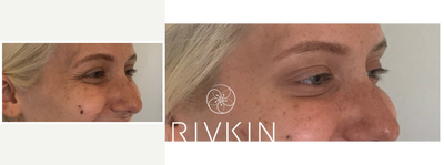 18-24 year old woman treated with Dysport around the eyes - Bright eyes! Dysport around the eyes to target crows feet!