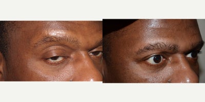 45-54 year old man treated with Eyebrow Transplant - Before and after eyebrow transplant.
