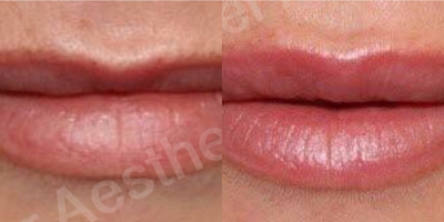 35-44 year old woman treated with Teosyal - This patient requested a subtle enhancement to her lips. She was treated with Teosyal RHA 3 using a cannula technique. Gentle volumisation was achieved whilst maintaining respect for the anatomy and facial harmony