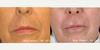 65-74 year old woman treated with Skin Rejuvenation - the resurfacing with Fraxel