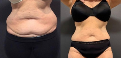 45-54 year old woman treated with Vanquish - Treatment with Vanquish and Exilis combination for body sculpting.
