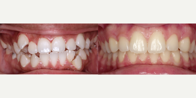 18-24 year old woman treated with InBrace - This patient was treated over a 14 month period using InBrace to correct crowding and an overbite.