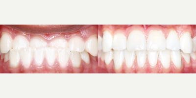 25-34 year old woman treated with InBrace - This patient was treated with InBrace to fix a severe crossbite.