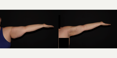 35-44 year old woman treated with Lipedema Surgery, Laser Liposuction, Renuvion - Lipedema reduction surgery to bilateral arms.