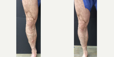 Varithena combined with a Phlebectomy and Sclerotherapy - This patient had great results with Varithena being the primary treatment used here. There were a few spots that it was beneficial to do a phlebectomy, but the combination turned out beautifully!