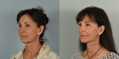 65-74 year old woman treated with Laser Resurfacing - 68 year old female who underwent Facelift, Neck Lift, CO2 laser resurfacing and fat grafting 3 months ago.