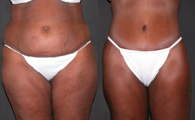 Tummy Tuck with Flank Liposuction - 
	Abdominoplasty or Full Tummy Tuck with muscle repair and waist/ flank liposuction. He uses a double stitch muscle flattening technique and ensures that the scar is low, the belly button is contoured and natural looking and the waist complements the tummy.
