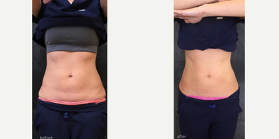 25-34 year old woman treated with UltraShape Power - Client treated with UltraShape Power for body contouring
