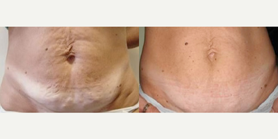 Woman treated with Velashape - Woman treated with Velashape