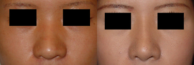 25-34 year old woman treated with Asian Rhinoplasty - Individual results may vary