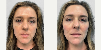35-44 year old woman treated with Chin Filler, Dermal Fillers - This is a 41-year-old female who is interested in facial rejuvenation. She felt that she looked tired all the time and just wanted a refreshed look. Filler was placed in her midface and undereye area initially. When she returned 3 weeks later, additional filler was added to the midface as well as to the chin for facial balancing
