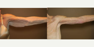 55-64 year old woman treated with Arm Lift - arm lift