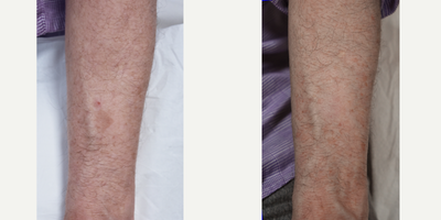 Los Angeles age spot removal before and after photos. - Are you worried about age spots on the hands, arms or legs?  Regardless of what area of the body you have brown spots, we can remove them.  Approach your day with confidence knowing you're putting your best self forward.