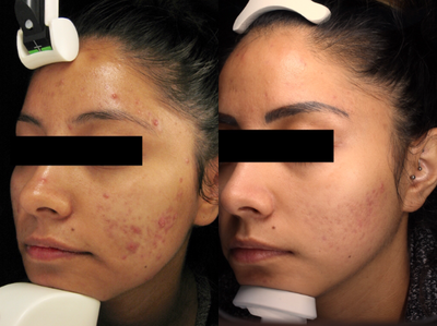 25-34 year old woman treated with Intracel - Patient had a series of Intracel treatments over the course of 2 years to treat cystic acne and scarring