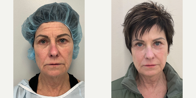 45-54 year old woman treated with Brow Lift, Dermal Fillers, Double Eyelid Surgery - Surgery and fillers.